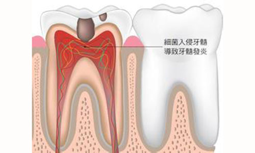 根管治疗与广东省口腔健康，专业治疗，守护口腔健康