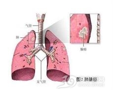 肺腺癌死前三个月症状深度解析