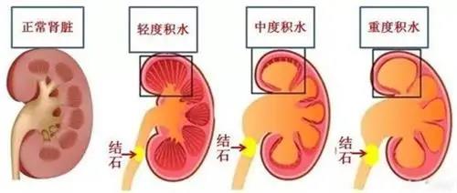 肾积水半个月，症状、原因及治疗方法