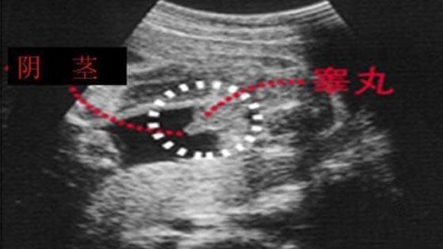 六个月B超下体男孩图，探索胎儿性别的神秘面纱