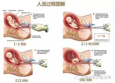 关于怀孕七个月打胎的复杂问题